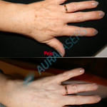 Pigmentacije ruke