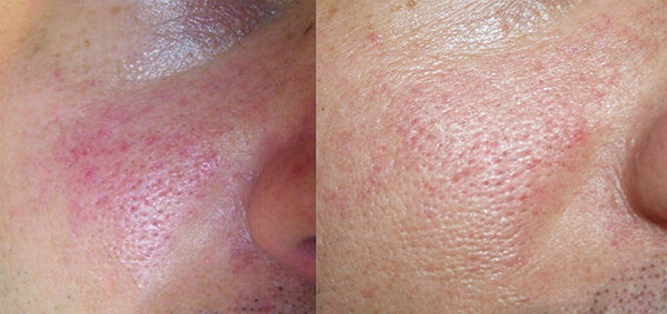 prije (slika lijevo) - nakon 2 tretmana (slika desno)